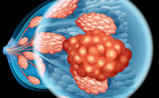 Câncer de mama: pequenos tumores estão entre os mais agressivos