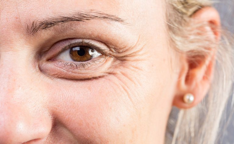 Rugas para pés de galinha? Dicas de especialistas